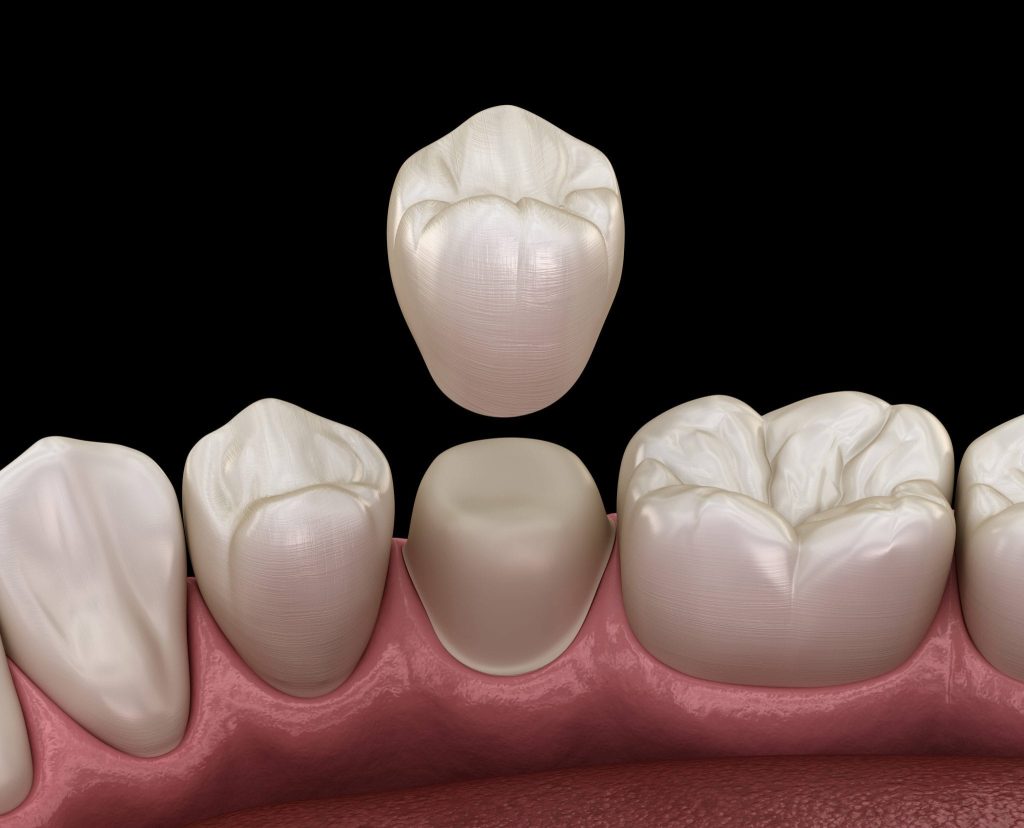 Ceramic-Crowns-and-Bridges
