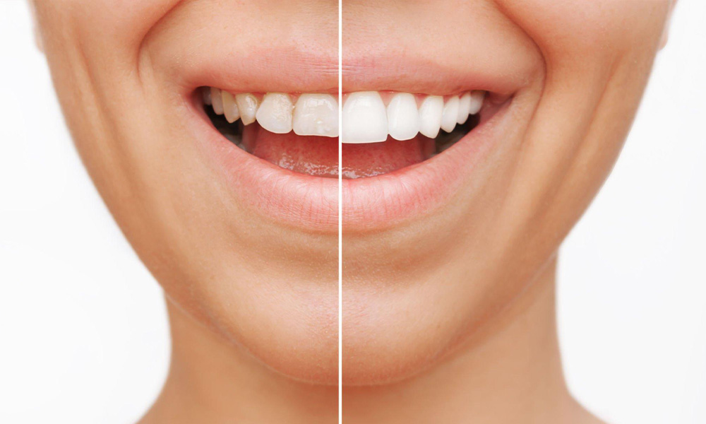 Dental-Veneers
