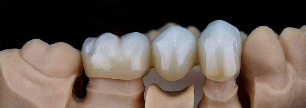 Porcelain-crowns