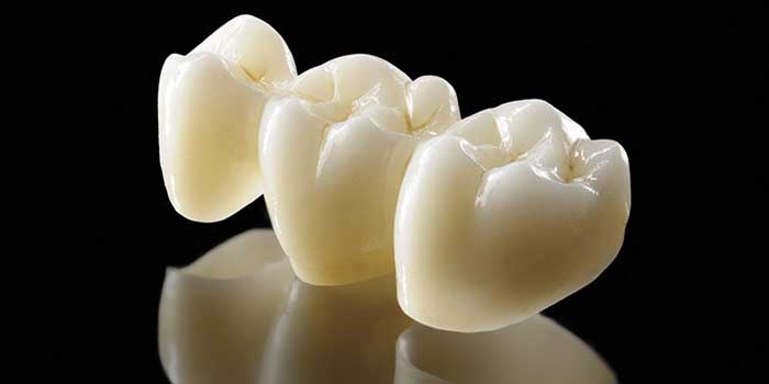 dental-bridges-header