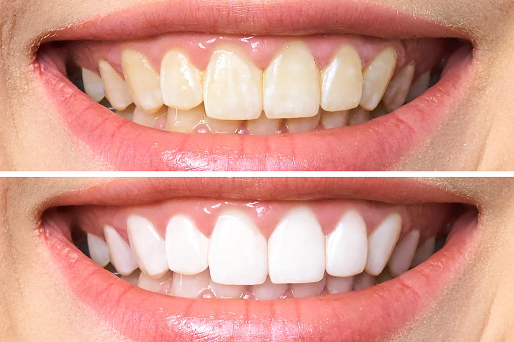 zoom teeth whitening